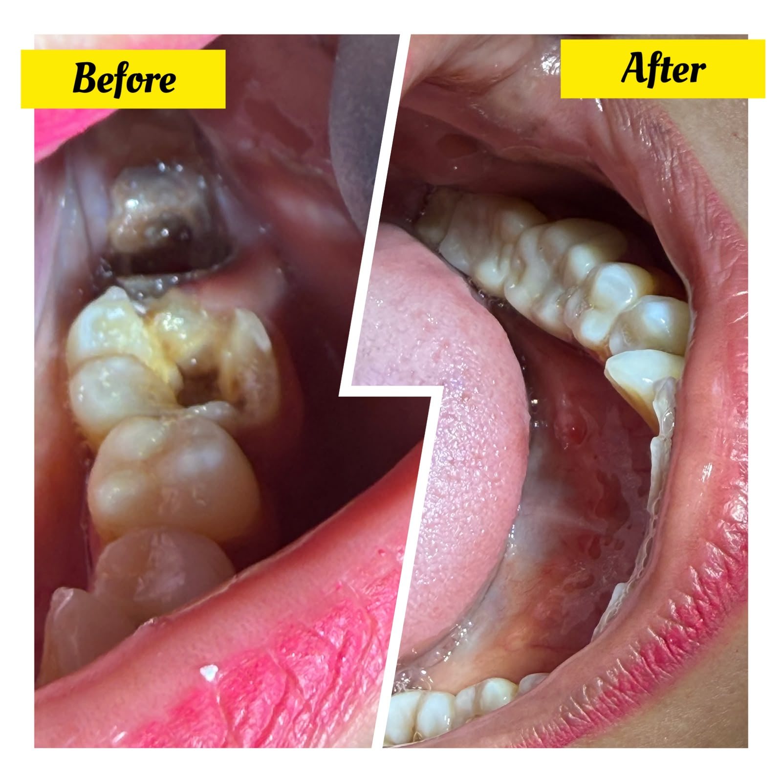 Before and after: decayed molar restored