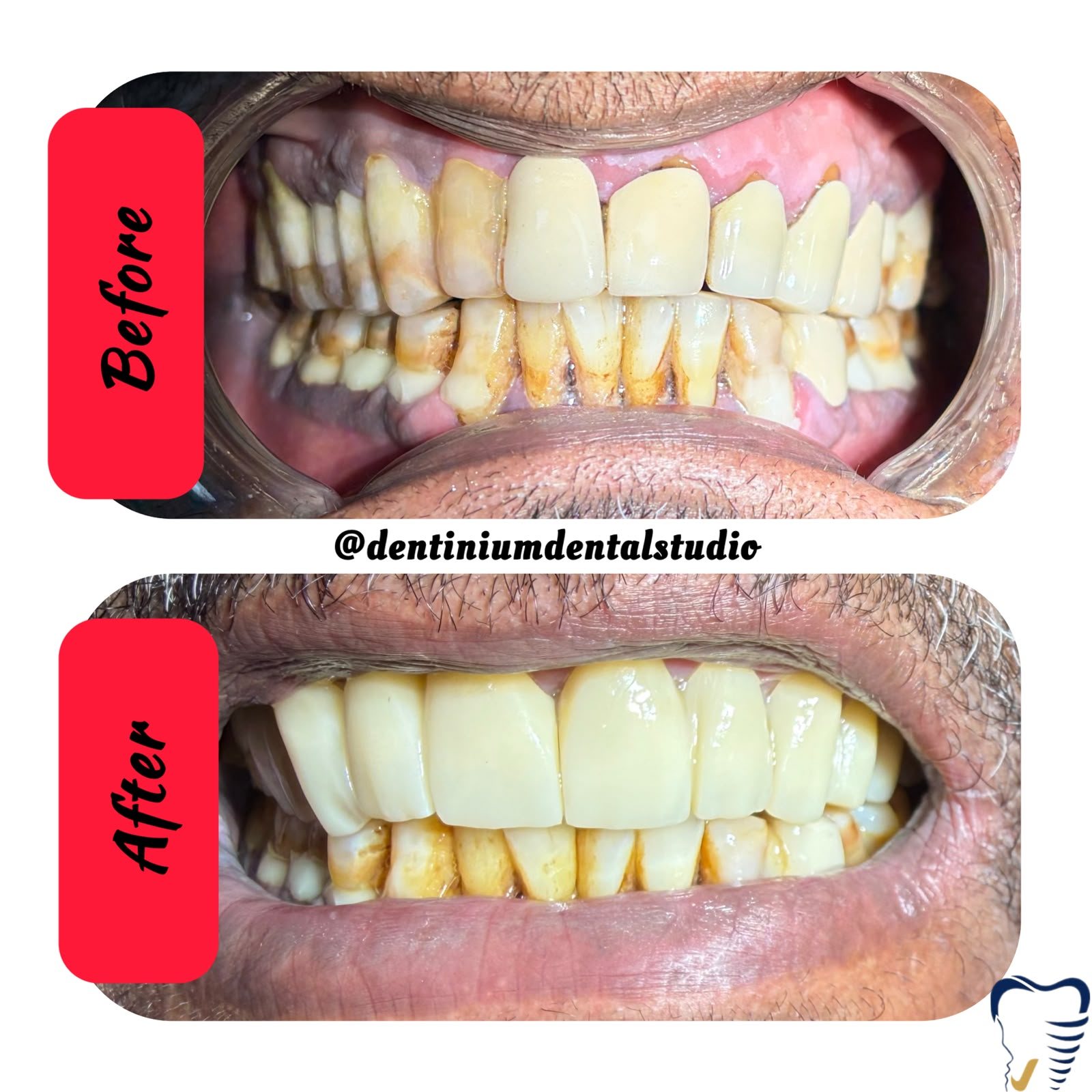 Before and after: upper front teeth restored with crowns