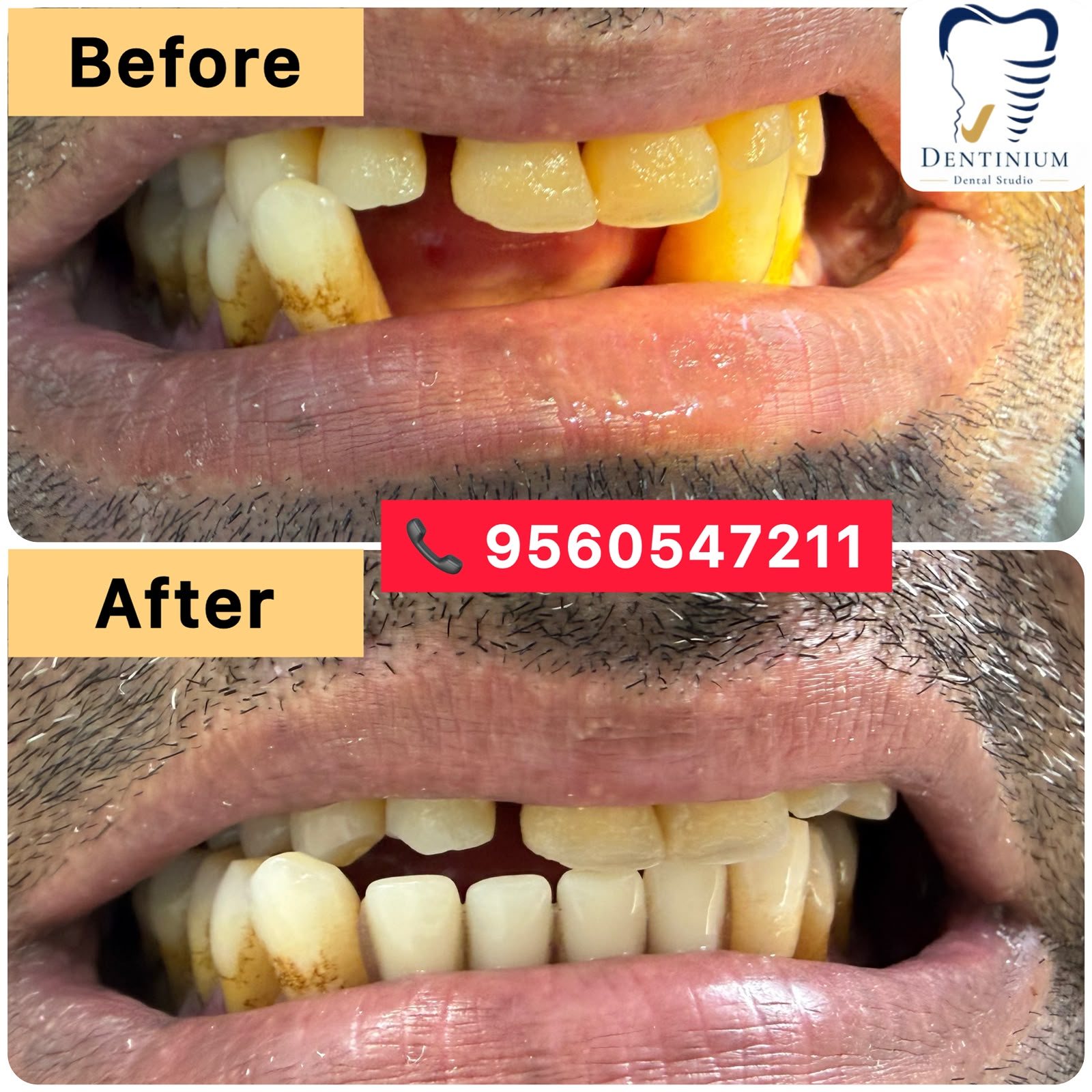 Before and after: missing lower front teeth replaced