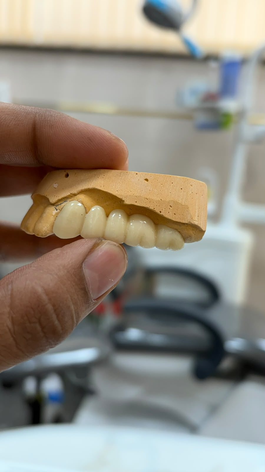 A ceramic bridge on the working model before fitting