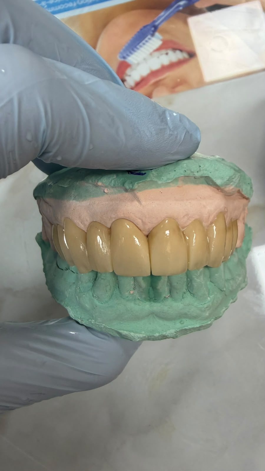 Full-arch crowns checked on the model.