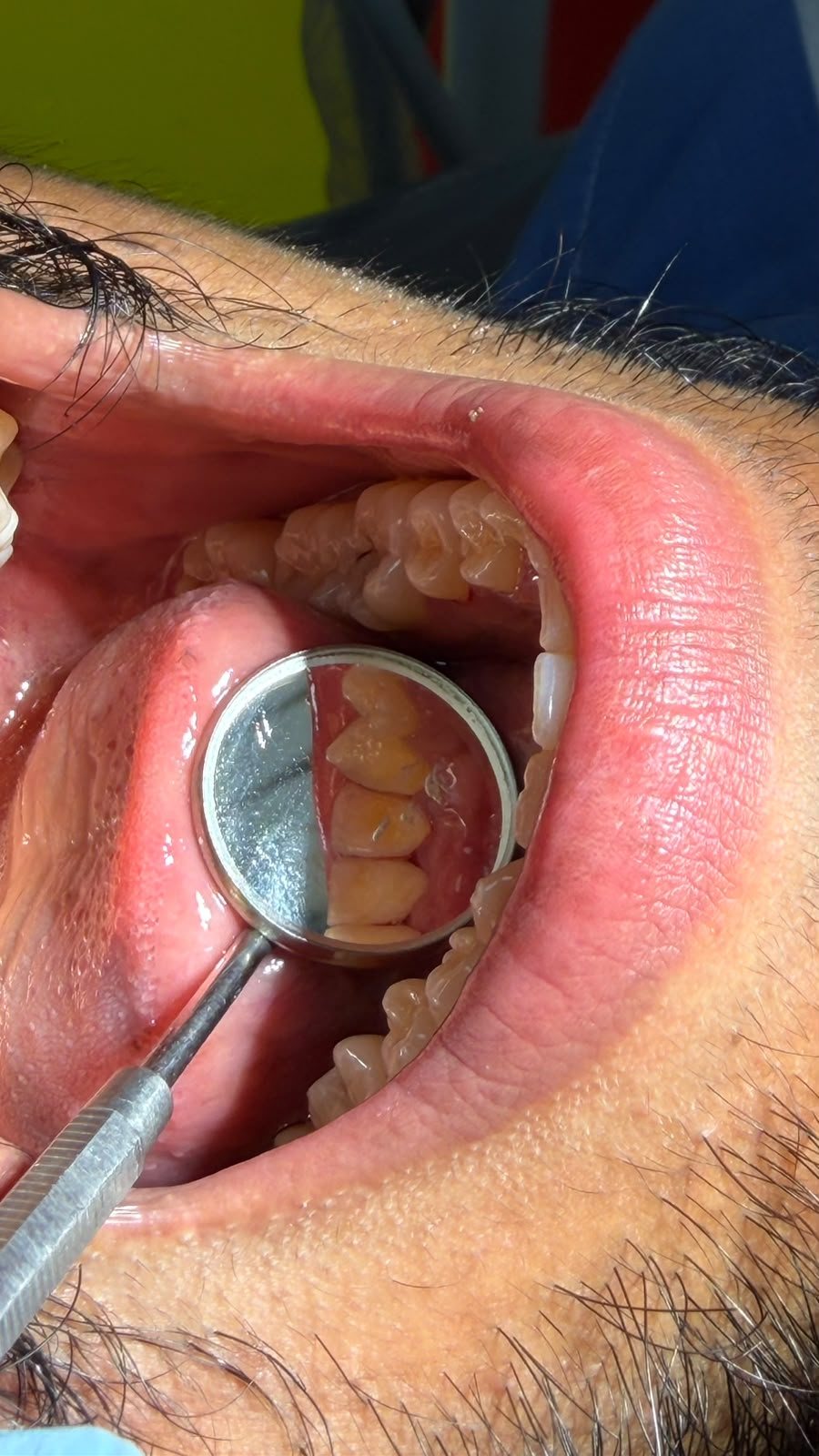 Intraoral examination with a dental mirror