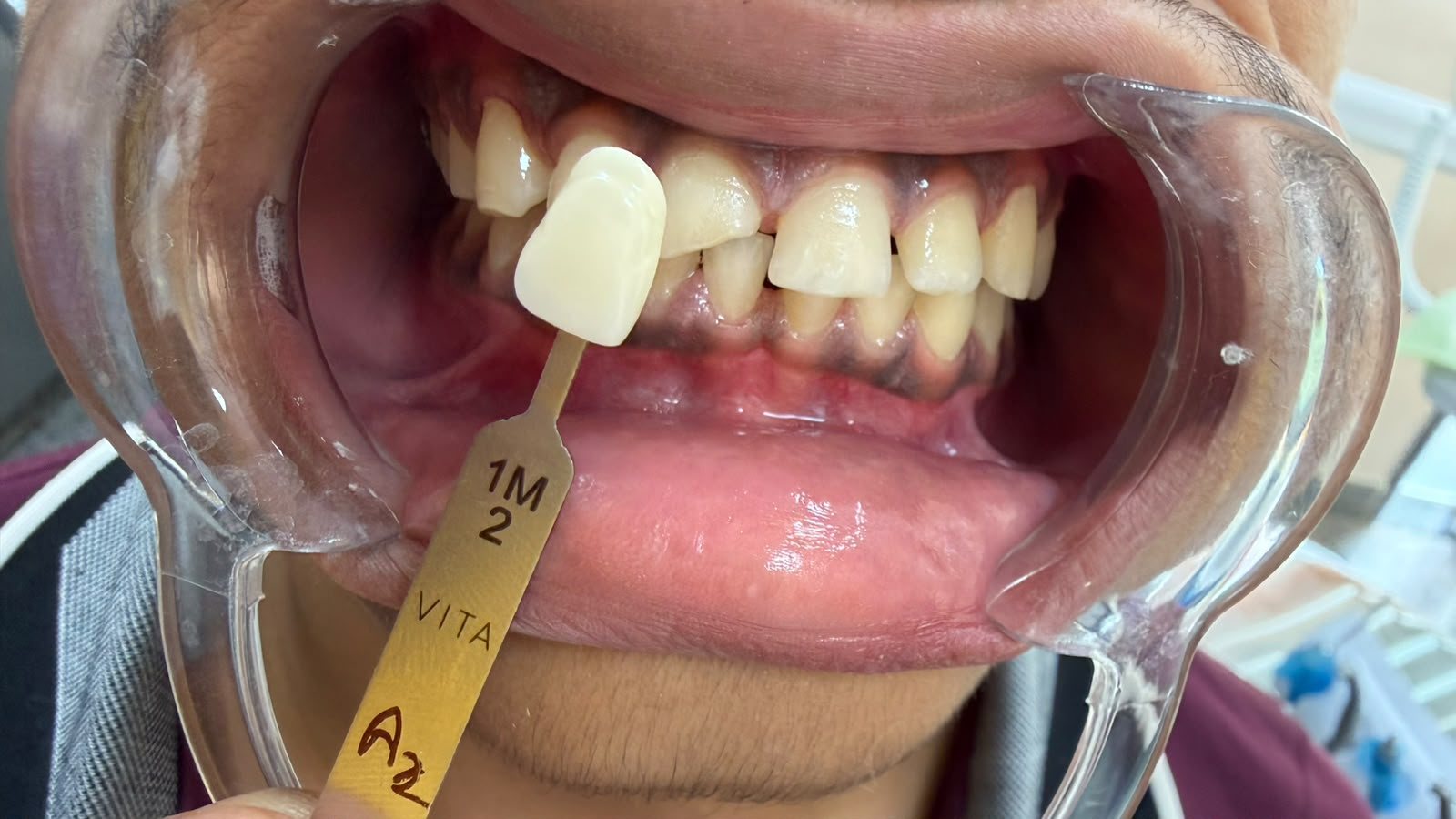 Matching tooth shade with a VITA shade guide
