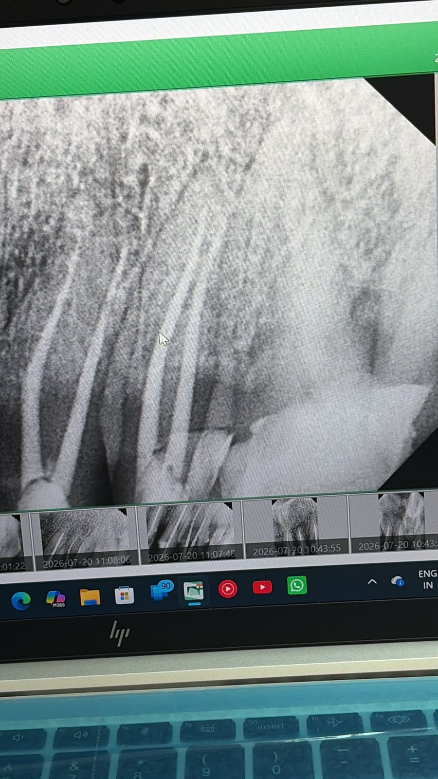 Digital X-ray confirming a completed root canal filling.
